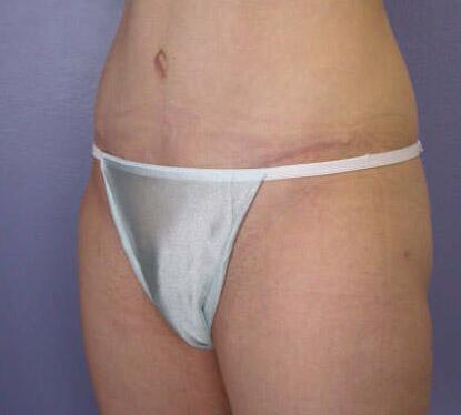 Liposuction Before & After Image