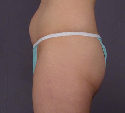 Liposuction Before & After Image