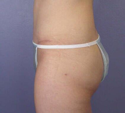 Liposuction Before & After Image