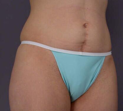 Liposuction Before & After Image