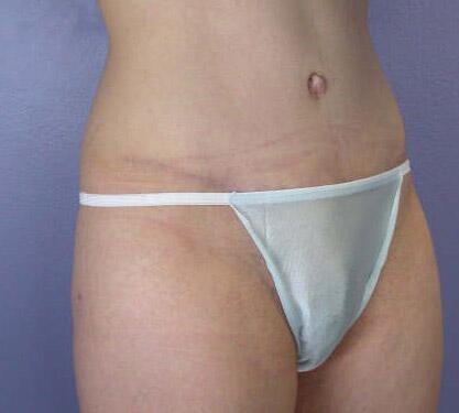 Liposuction Before & After Image