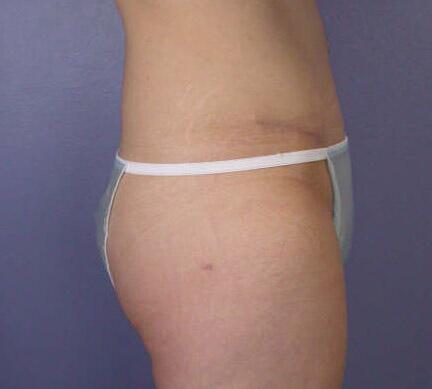 Liposuction Before & After Image