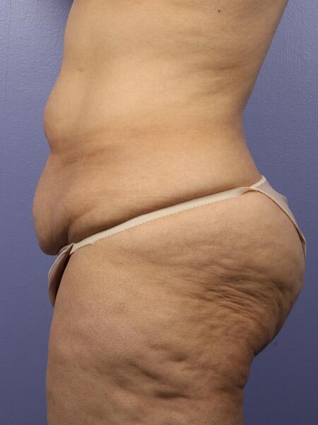 Liposuction Before & After Image