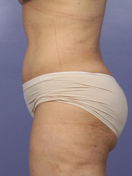 Liposuction Before & After Image