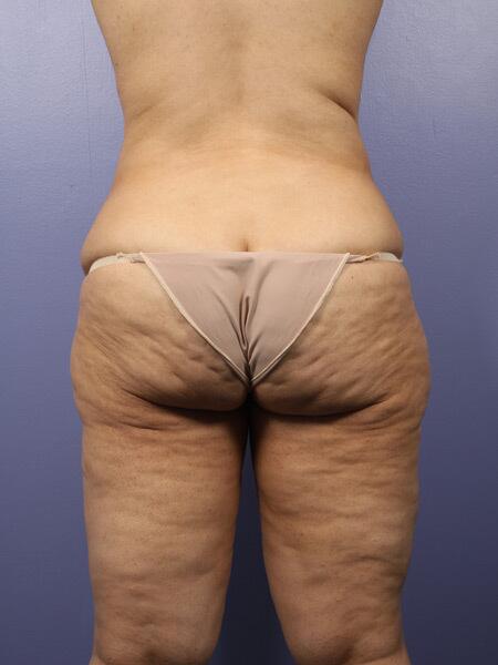 Liposuction Before & After Image