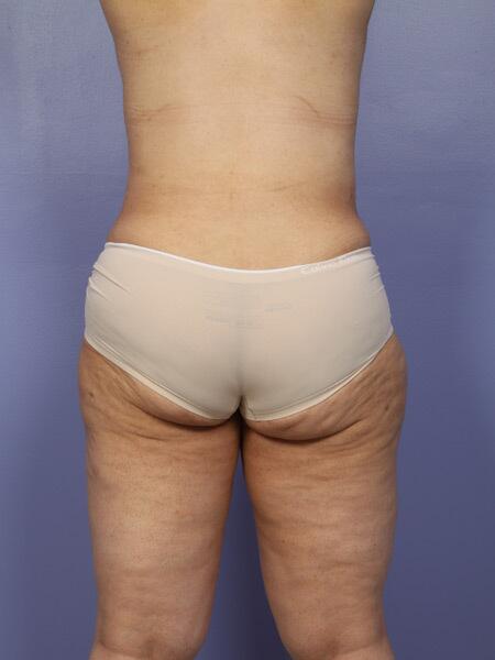 Liposuction Before & After Image