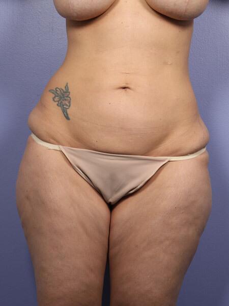 Liposuction Before & After Image