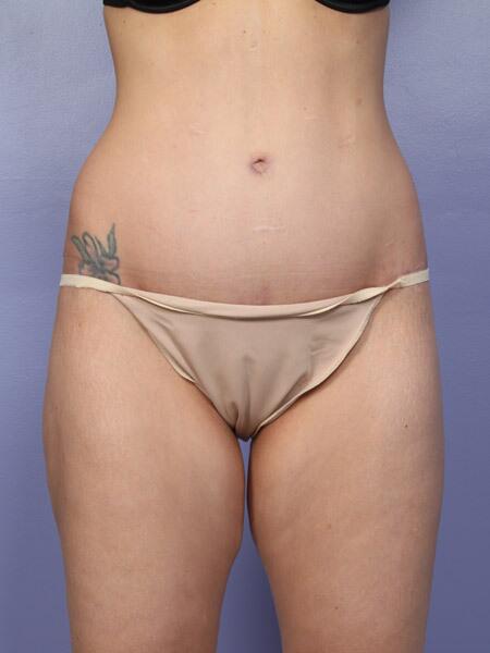 Liposuction Before & After Image