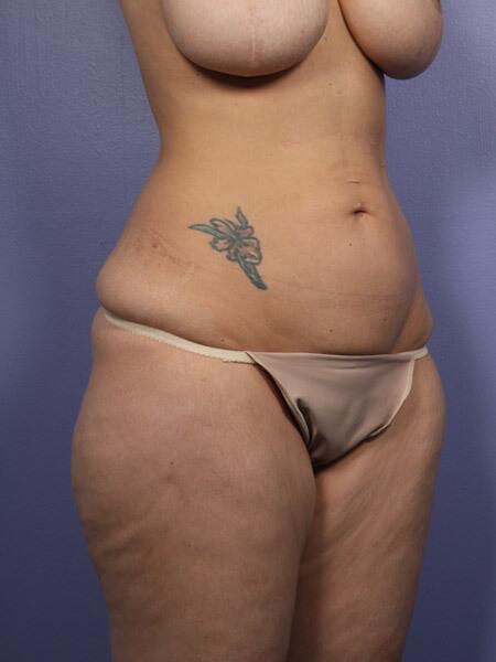 Liposuction Before & After Image