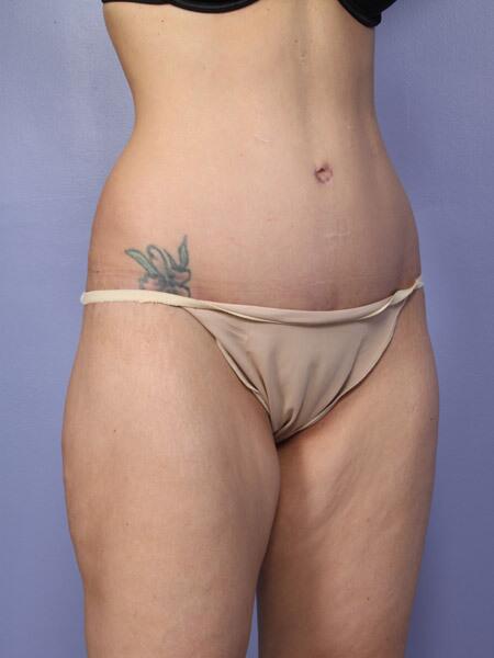 Liposuction Before & After Image