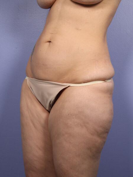 Liposuction Before & After Image