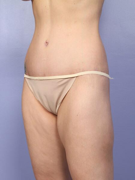 Liposuction Before & After Image