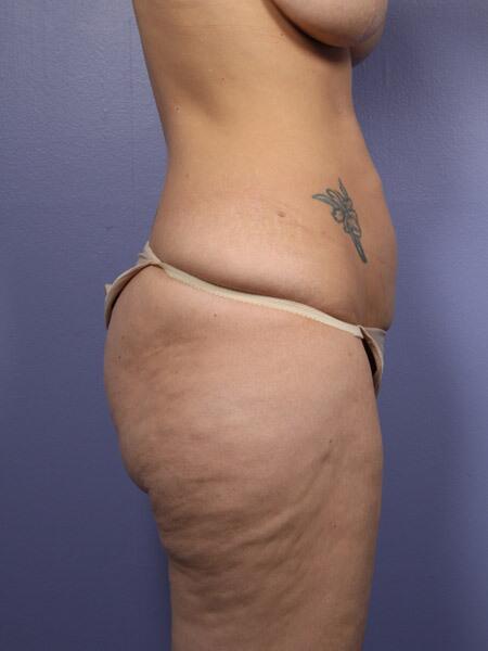 Liposuction Before & After Image