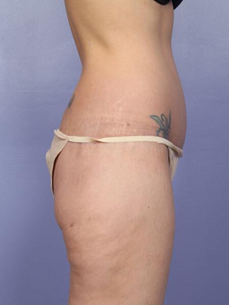 Liposuction Before & After Image