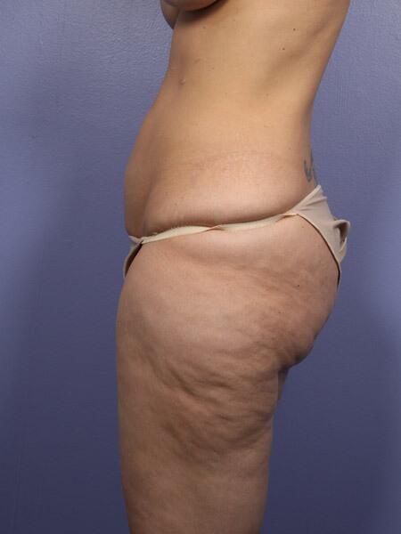 Liposuction Before & After Image