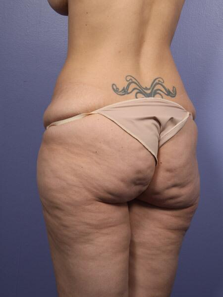 Liposuction Before & After Image