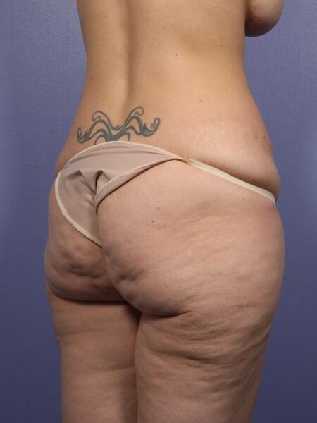 Liposuction Before & After Image