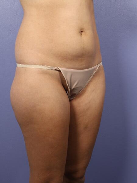 Liposuction Before & After Image