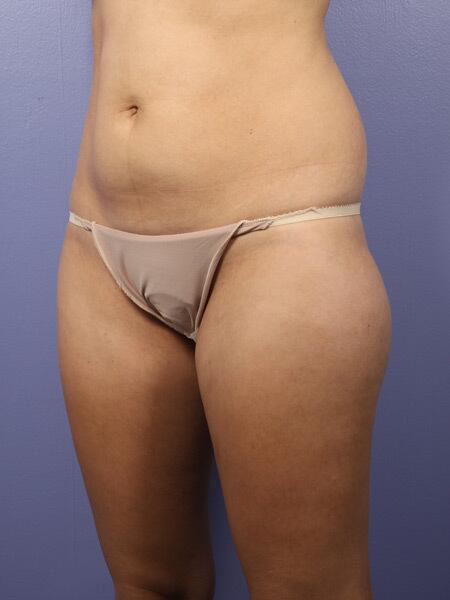 Liposuction Before & After Image