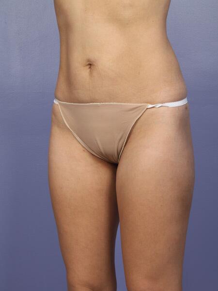 Liposuction Before & After Image