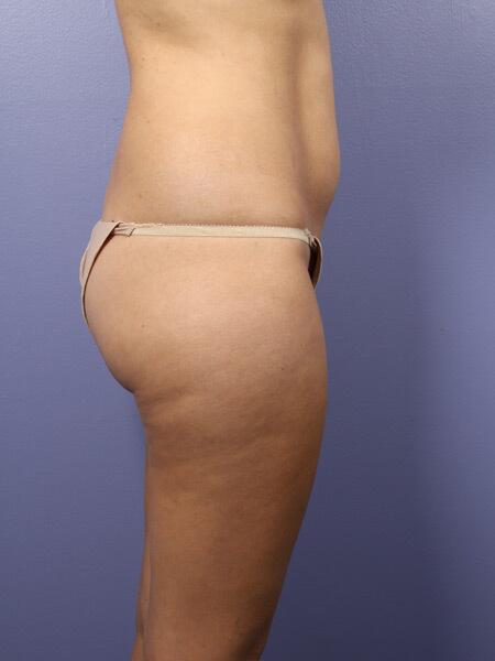 Liposuction Before & After Image