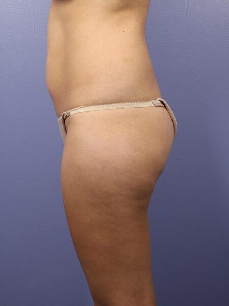 Liposuction Before & After Image