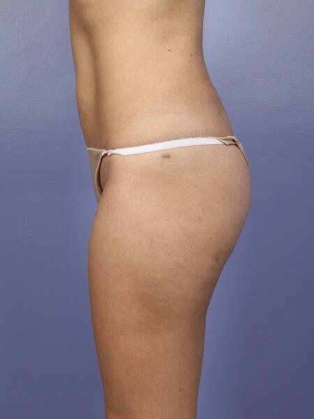 Liposuction Before & After Image