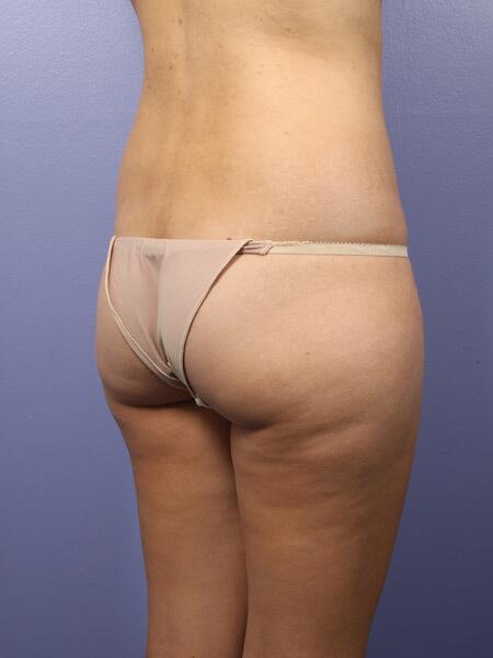 Liposuction Before & After Image