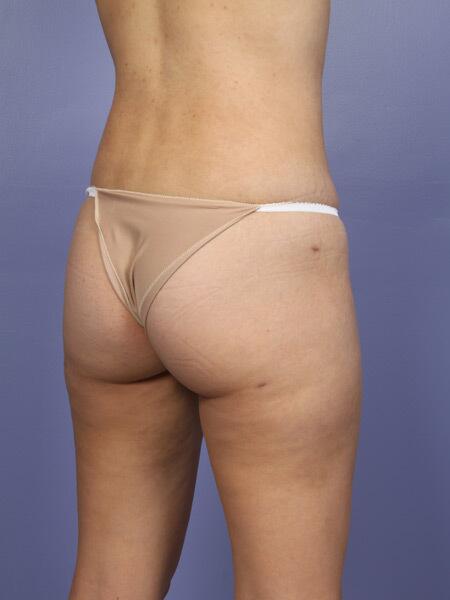 Liposuction Before & After Image