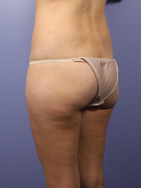 Liposuction Before & After Image