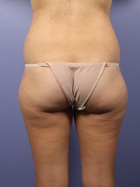 Liposuction Before & After Image