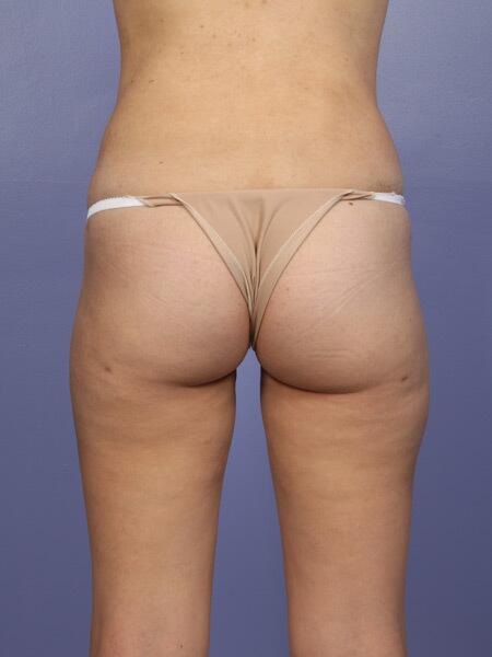 Liposuction Before & After Image