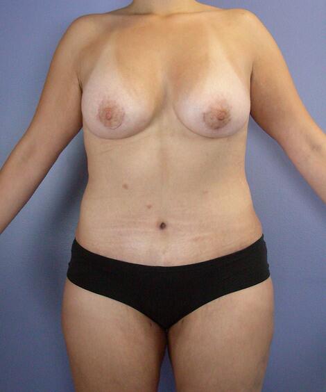 Liposuction Before & After Image