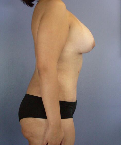 Liposuction Before & After Image