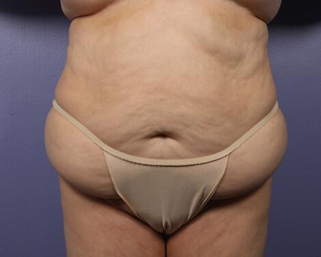 Liposuction Before & After Image