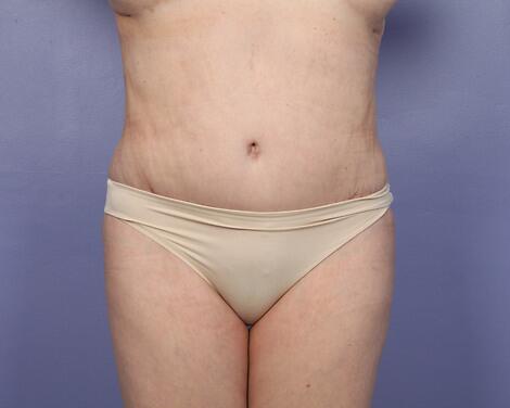 Liposuction Before & After Image