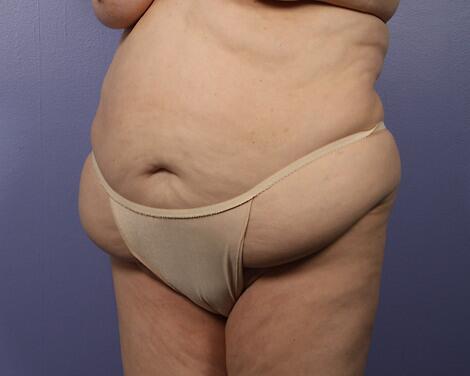 Liposuction Before & After Image