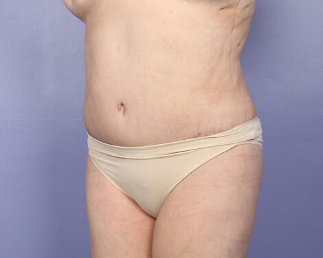 Liposuction Before & After Image