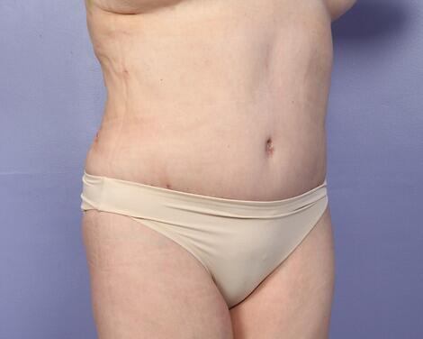 Liposuction Before & After Image