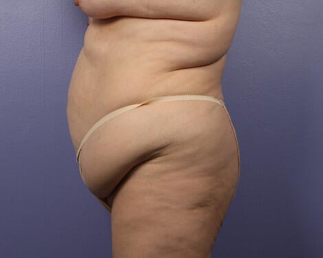 Liposuction Before & After Image