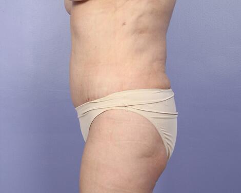 Liposuction Before & After Image