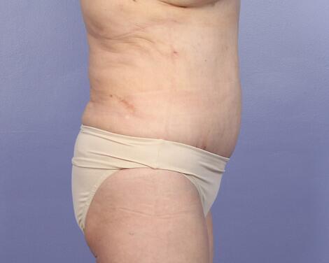 Liposuction Before & After Image