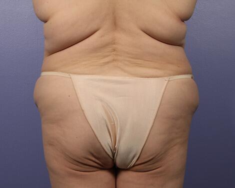 Liposuction Before & After Image