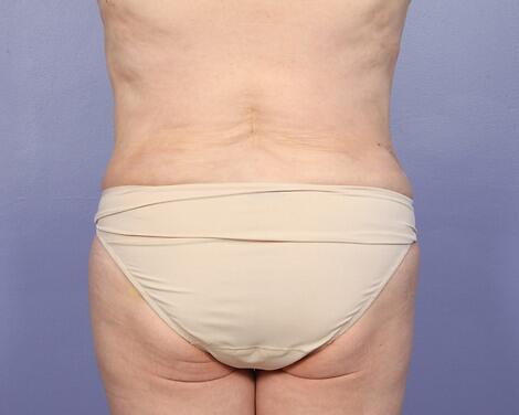 Liposuction Before & After Image