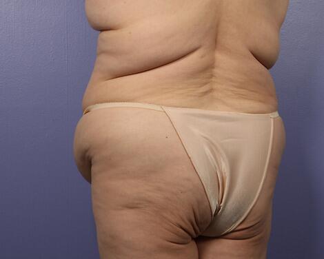 Liposuction Before & After Image