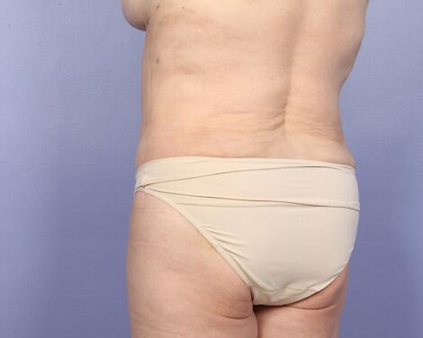 Liposuction Before & After Image