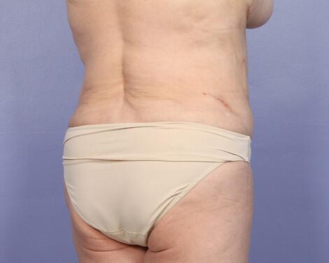 Liposuction Before & After Image