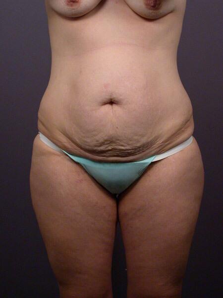 Liposuction Before & After Image