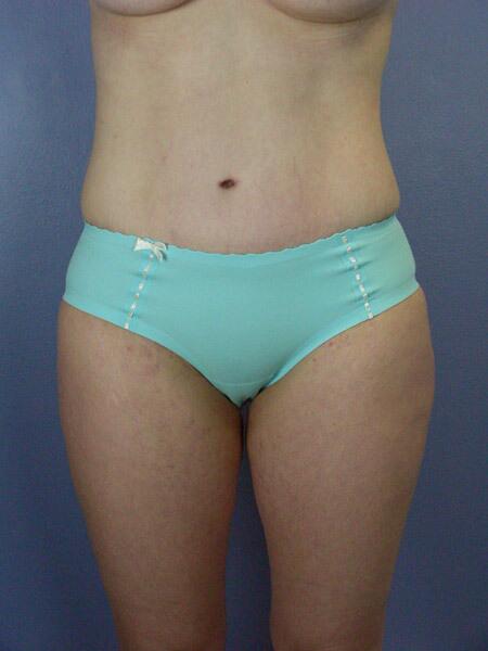 Liposuction Before & After Image