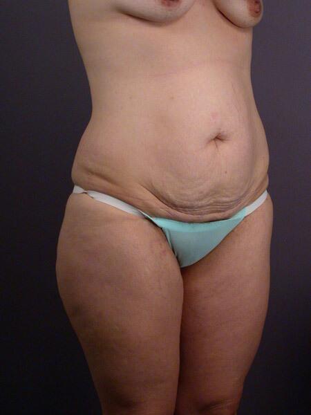 Liposuction Before & After Image